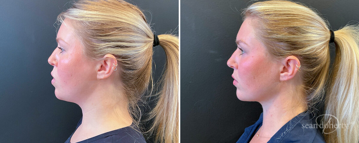 Liposuction Before and After Photos in Boston, MA, Patient 16625