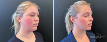 Liposuction Before and After Photos in Boston, MA, Patient 16625