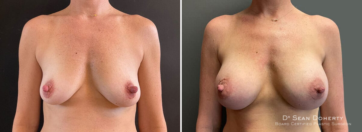Breast Augmentation Before and After Photos in Boston, MA, Patient 10098