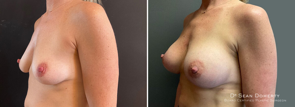 Breast Augmentation Before and After Photos in Boston, MA, Patient 10098