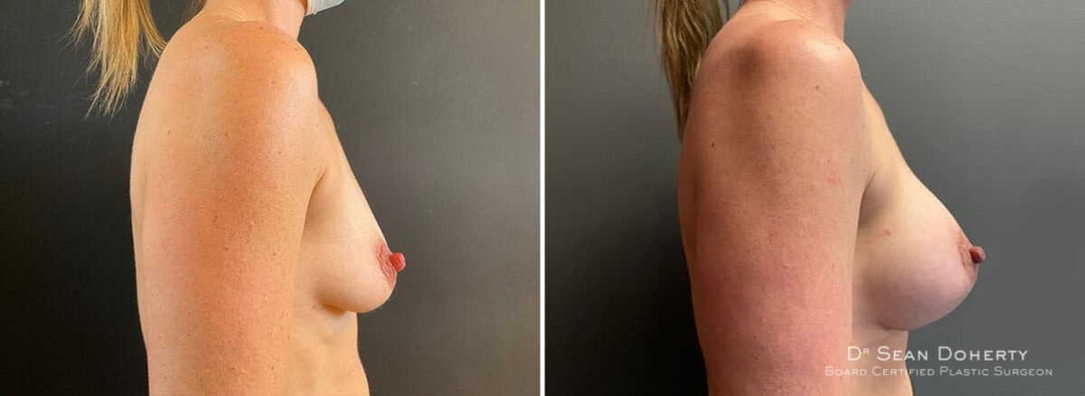 Breast Augmentation Before and After Photos in Boston, MA, Patient 10098