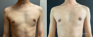 Gynecomastia Before and After Photos in Boston, MA, Patient 10154