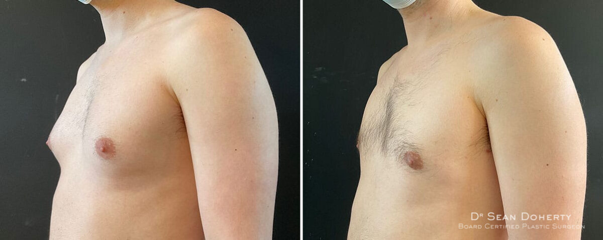 Gynecomastia Before and After Photos in Boston, MA, Patient 10164