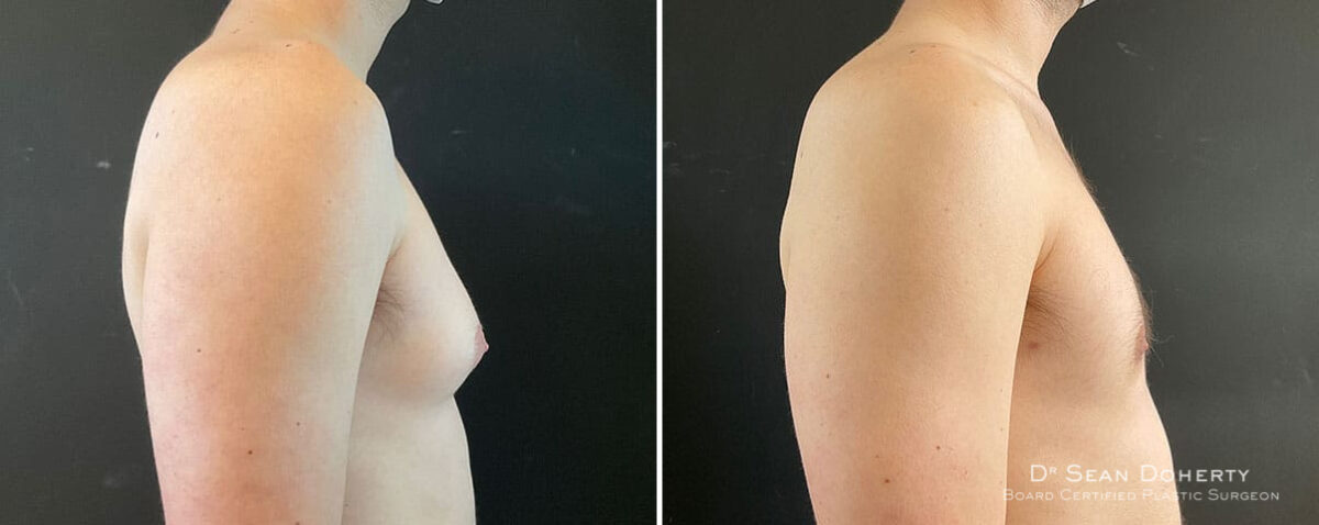 Gynecomastia Before and After Photos in Boston, MA, Patient 10164
