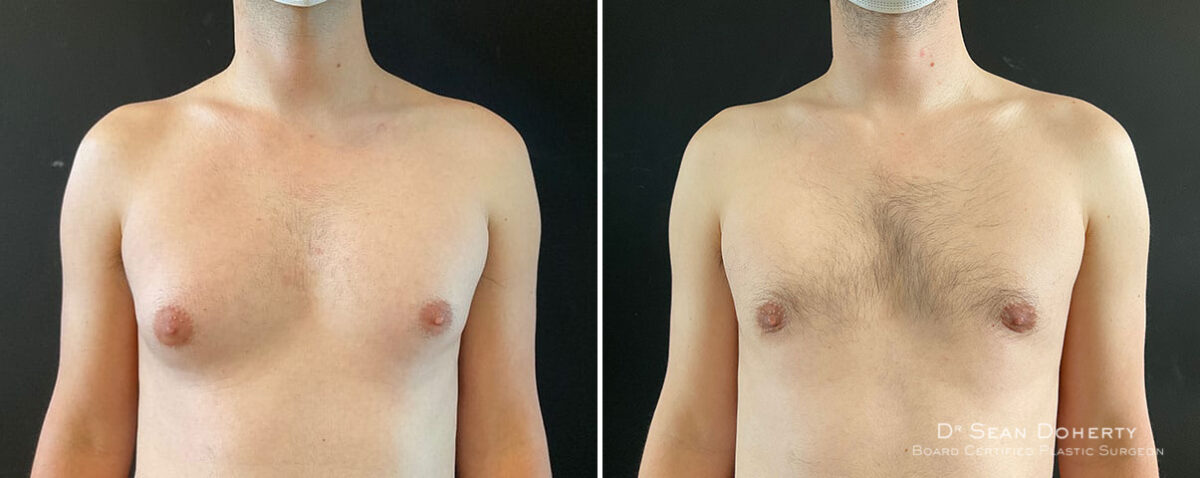 Gynecomastia Before and After Photos in Boston, MA, Patient 10164