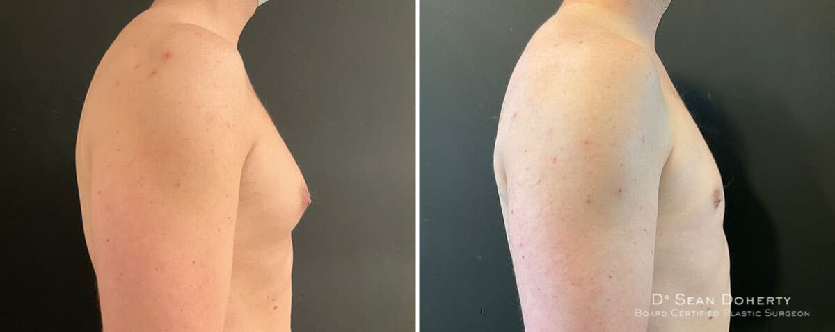 Gynecomastia Before and After Photos in Boston, MA, Patient 10179
