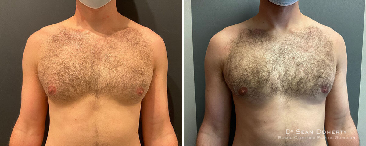 Gynecomastia Before and After Photos in Boston, MA, Patient 10190