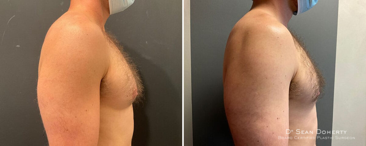 Gynecomastia Before and After Photos in Boston, MA, Patient 10190