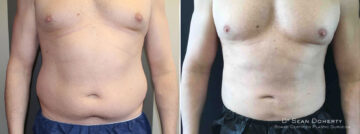 Male Liposuction Before and After Photos in Boston, MA, Patient 10230
