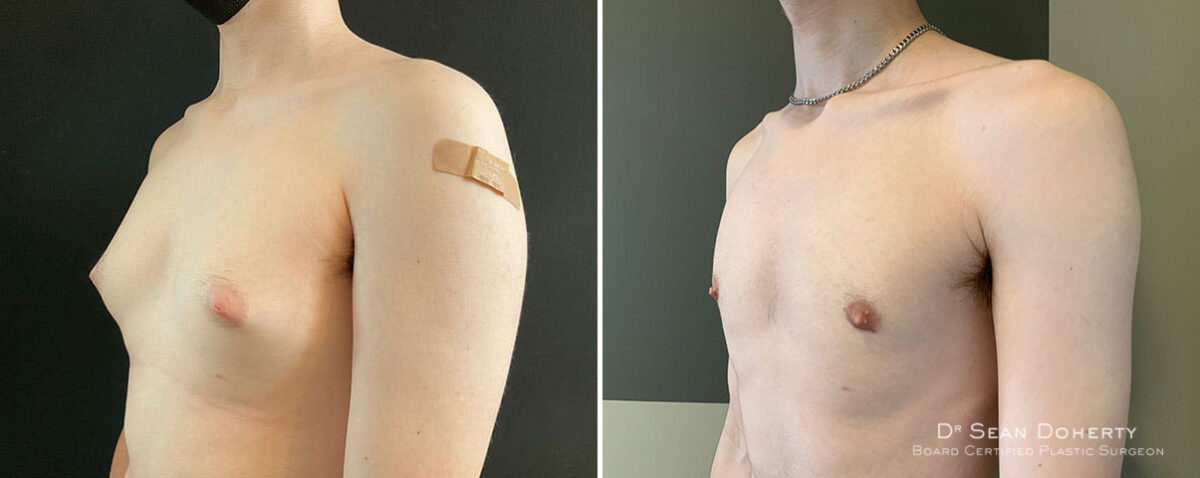 Gynecomastia Before and After Photos in Boston, MA, Patient 10411