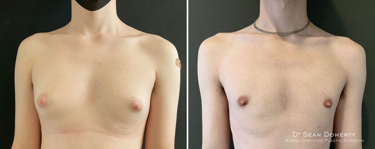 Gynecomastia Before and After Photos in Boston, MA, Patient 10411