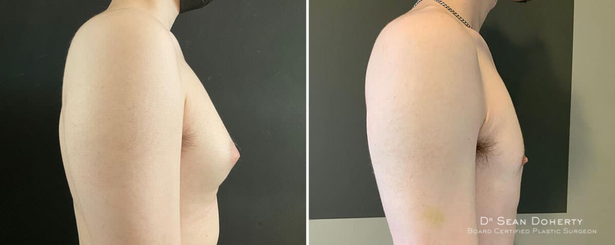 Gynecomastia Before and After Photos in Boston, MA, Patient 10411