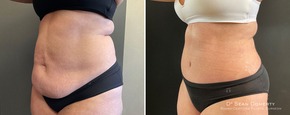Tummy Tuck Before and After Photos in Boston, MA, Patient 10421