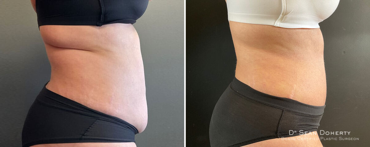 Tummy Tuck Before and After Photos in Boston, MA, Patient 10421