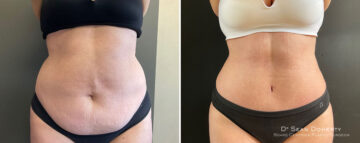 Tummy Tuck Before and After Photos in Boston, MA, Patient 10421