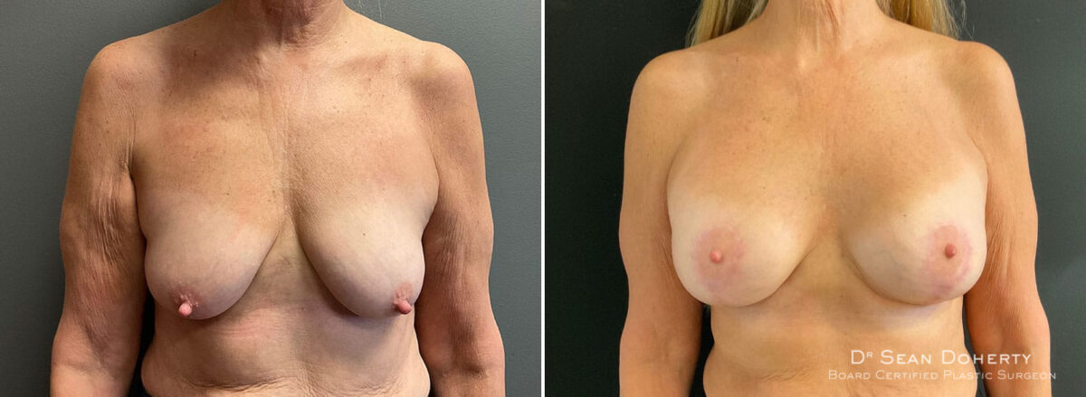 Breast Lift with Implants Before and After Photos in Boston, MA, Patient 10441