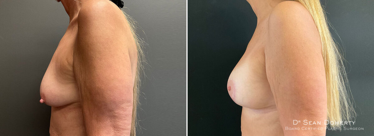 Breast Lift with Implants Before and After Photos in Boston, MA, Patient 10441