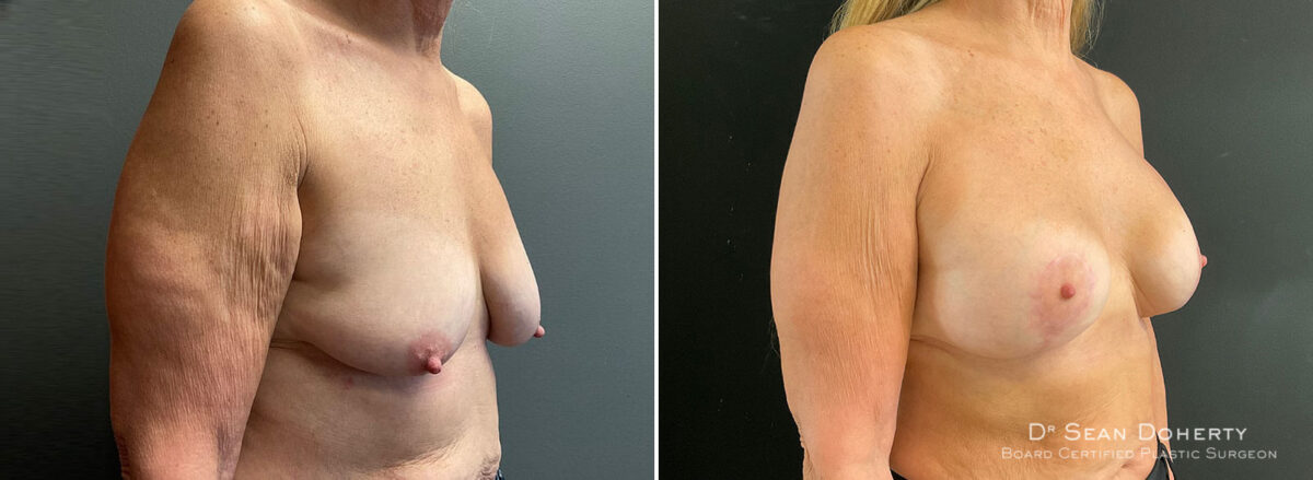 Breast Lift with Implants Before and After Photos in Boston, MA, Patient 10441
