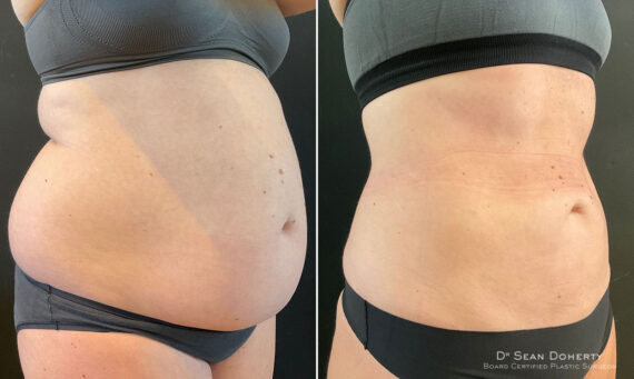 Liposuction Before and After Photos in Boston, MA, Patient 10486