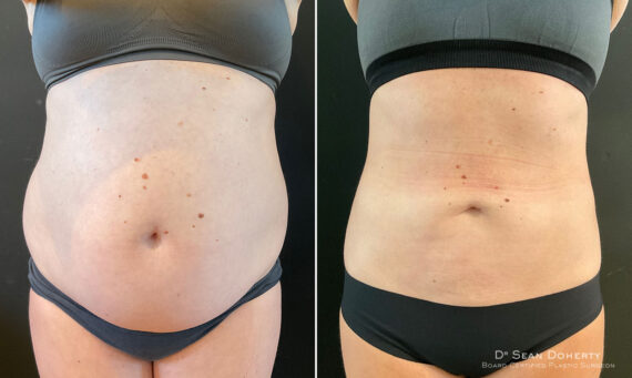 Liposuction Before and After Photos in Boston, MA, Patient 10486