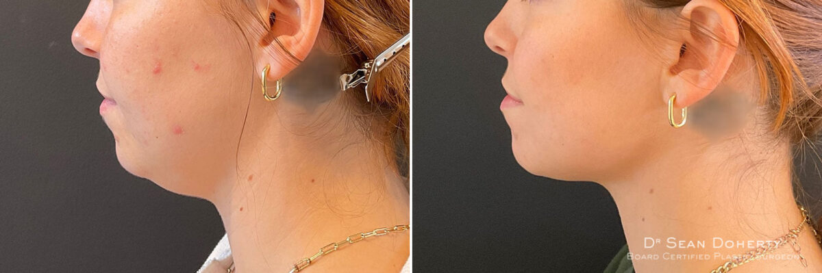 Liposuction Before and After Photos in Boston, MA, Patient 10497