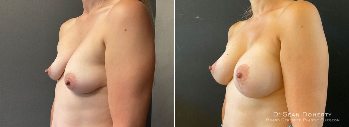 Breast Lift with Implants Before and After Photos in Boston, MA, Patient 10507
