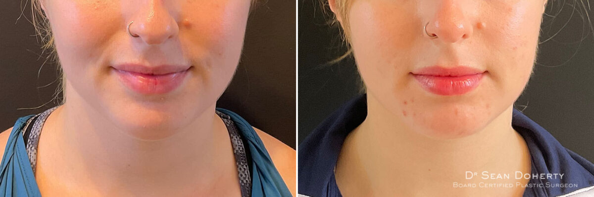 Liposuction Before and After Photos in Boston, MA, Patient 10517