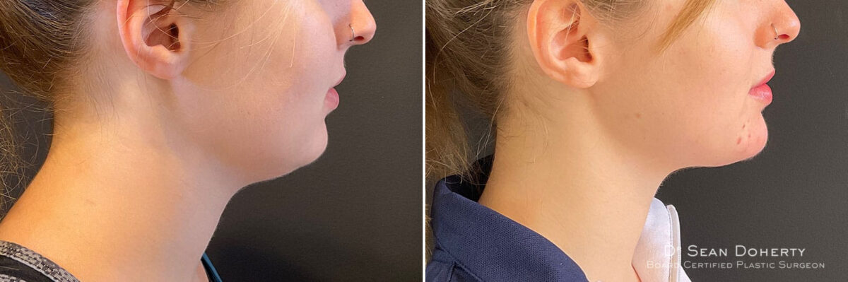 Liposuction Before and After Photos in Boston, MA, Patient 10517