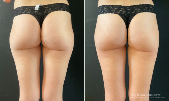 Liposuction Before and After Photos in Boston, MA, Patient 10527