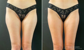 Liposuction Before and After Photos in Boston, MA, Patient 10527