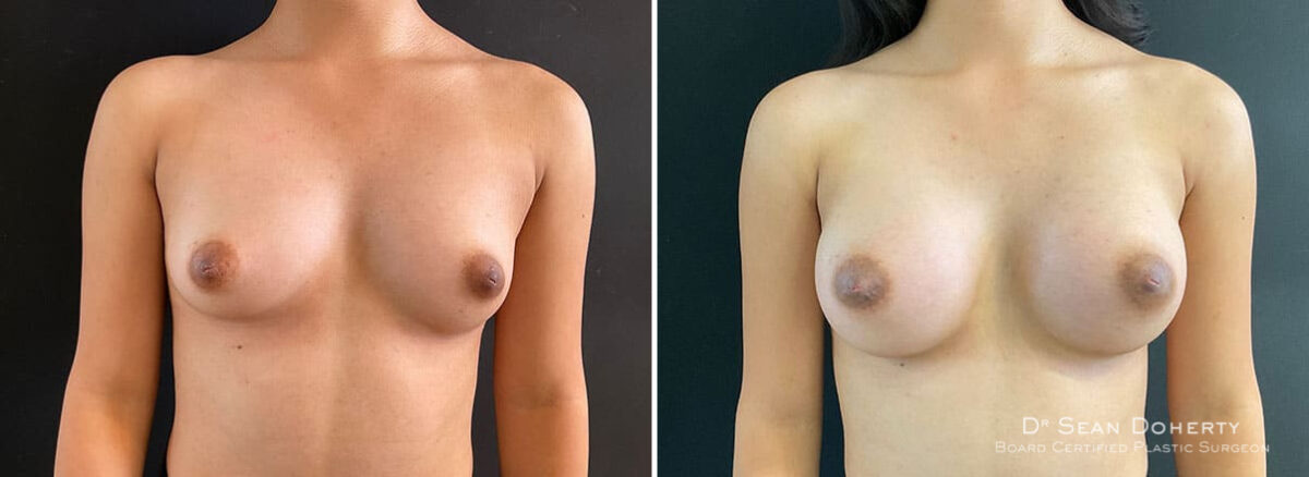 Breast Augmentation Before and After Photos in Boston, MA, Patient 10860