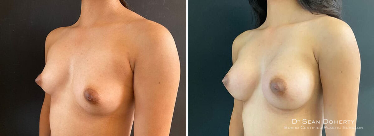 Breast Augmentation Before and After Photos in Boston, MA, Patient 10860