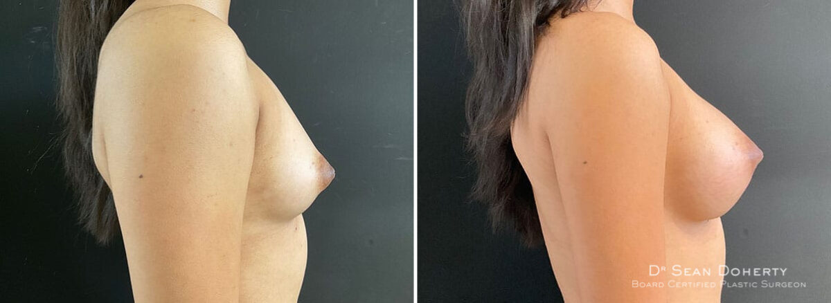 Breast Augmentation Before and After Photos in Boston, MA, Patient 10860