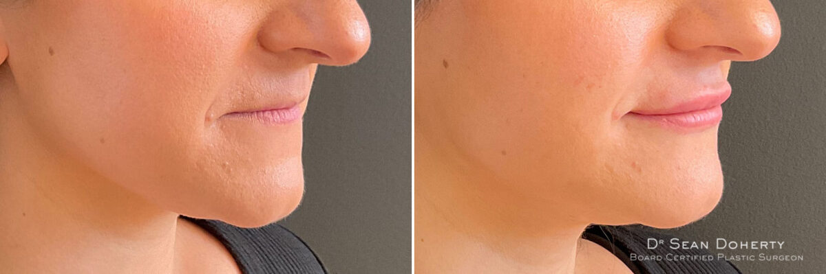 Dermal Fillers Before and After Photos in Boston, MA, Patient 10960