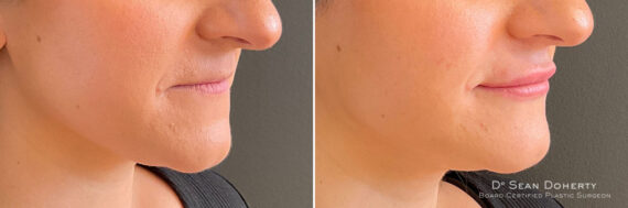Dermal Fillers Before and After Photos in Boston, MA, Patient 10960