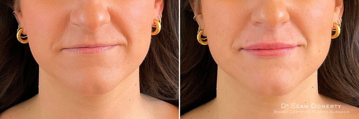 Dermal Fillers Before and After Photos in Boston, MA, Patient 10960