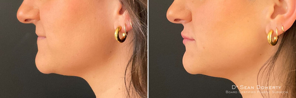 Dermal Fillers Before and After Photos in Boston, MA, Patient 10960