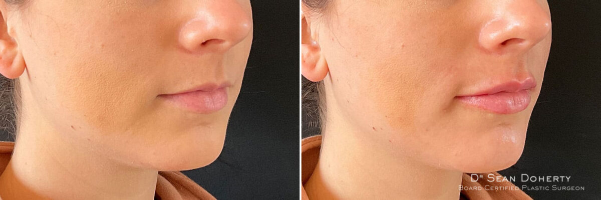 Dermal Fillers Before and After Photos in Boston, MA, Patient 10970
