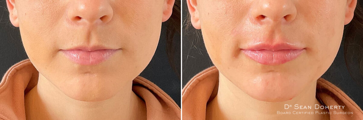 Dermal Fillers Before and After Photos in Boston, MA, Patient 10970