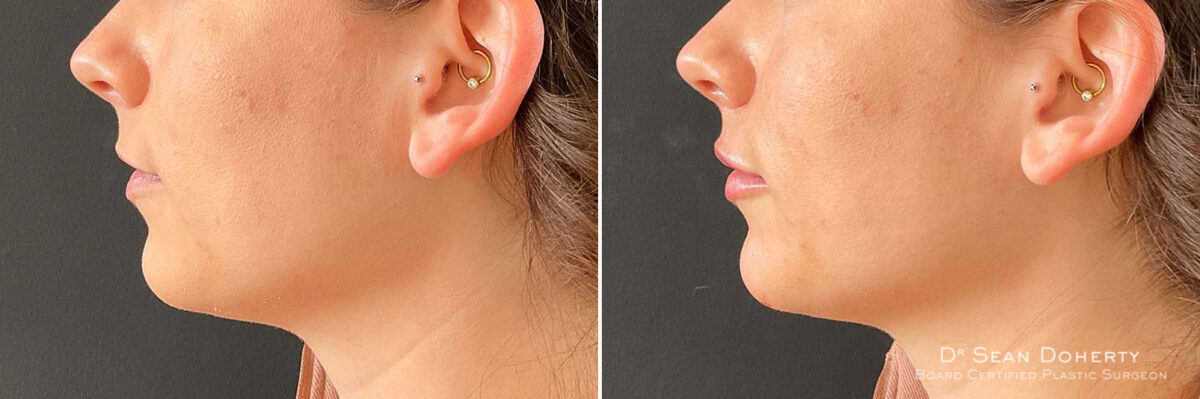 Dermal Fillers Before and After Photos in Boston, MA, Patient 10970