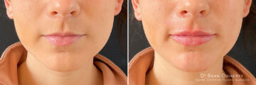 Dermal Fillers Before and After Photos in Boston, MA, Patient 10970
