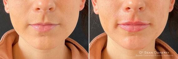 Lip Augmentation Before and After Photos in Boston, MA, Patient 10970