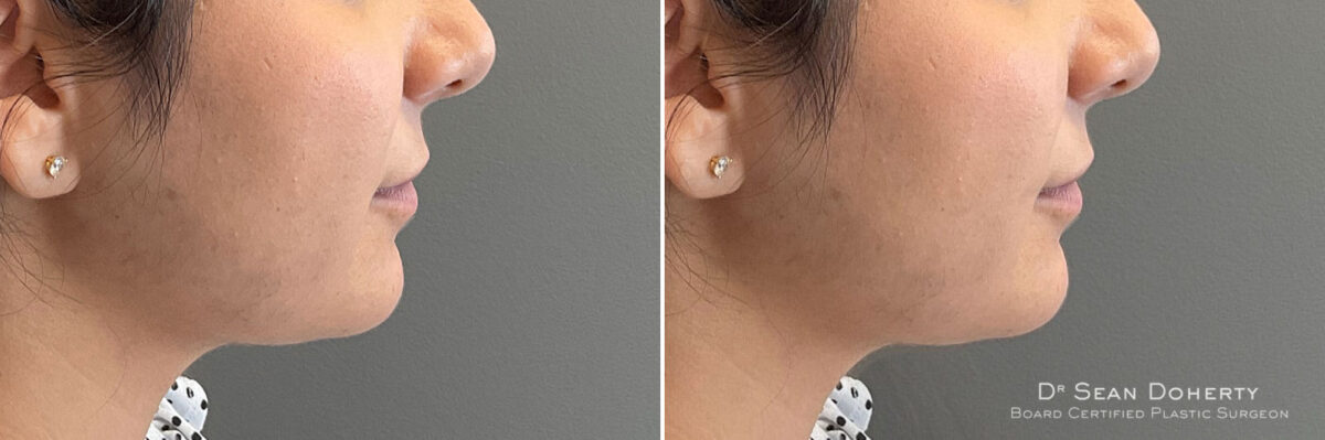 Dermal Fillers Before and After Photos in Boston, MA, Patient 10980