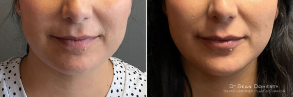 Dermal Fillers Before and After Photos in Boston, MA