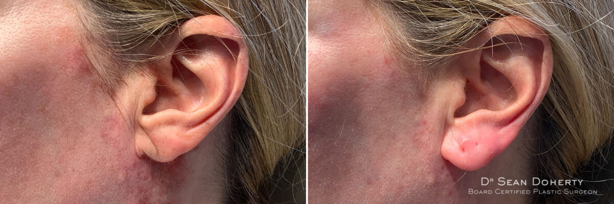 Dermal Fillers Before and After Photos in Boston, MA, Patient 10997
