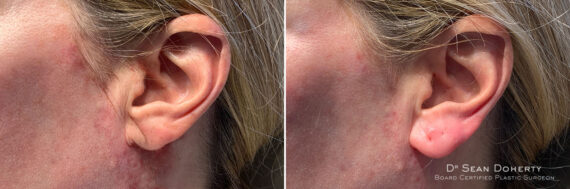 Dermal Fillers Before and After Photos in Boston, MA, Patient 10997