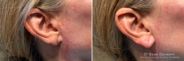 Dermal Fillers Before and After Photos in Boston, MA, Patient 10997