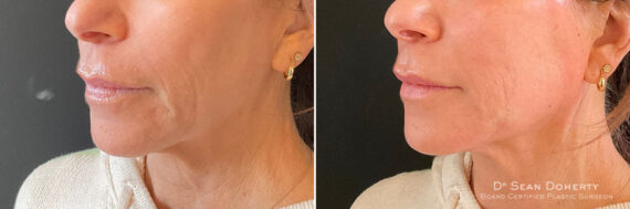 NovaThreads Before and After Photos in Boston, MA