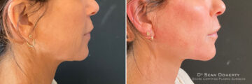NovaThreads Before and After Photos in Boston, MA, Patient 11004