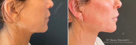 NovaThreads Before and After Photos in Boston, MA